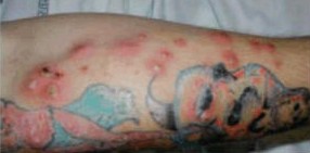 Tattoo Staph Infection